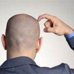 Melembapkan Kulit Kepala Yang Botak